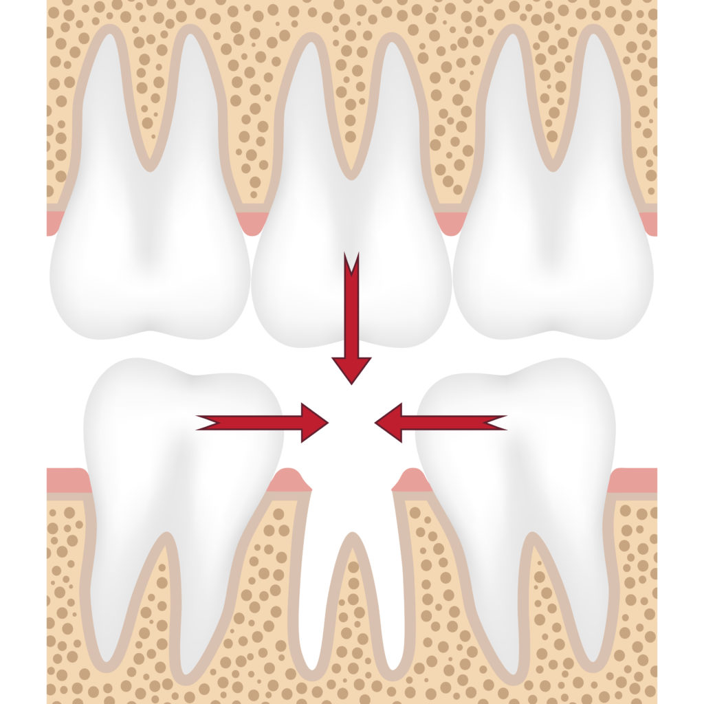 reinserting a knocked out tooth clipart